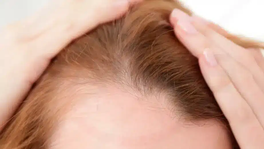 Entendendo a Alopecia Androgenética: Causas e Tratamentos